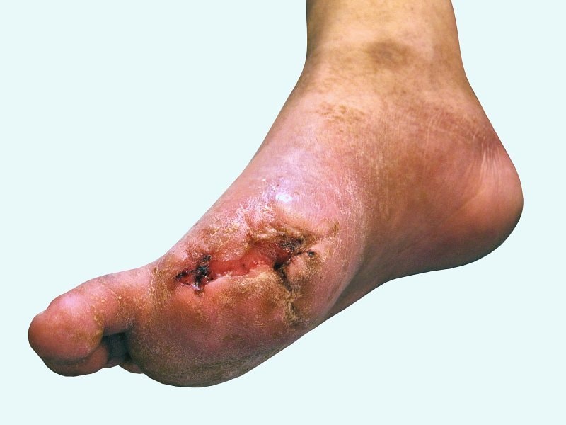 EpiFix Trumps Alternatives for Diabetic Foot Ulcer Wounds