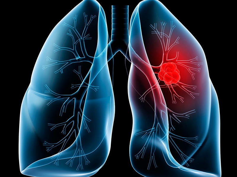 The Year in Lung Cancer: CT Screening, More Targeted Therapy