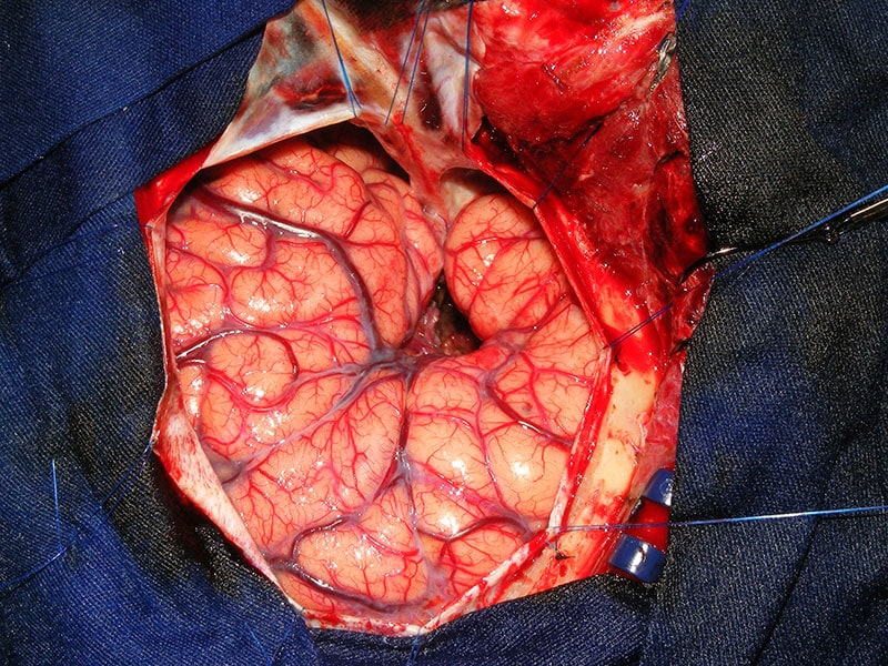 brain tumor removal