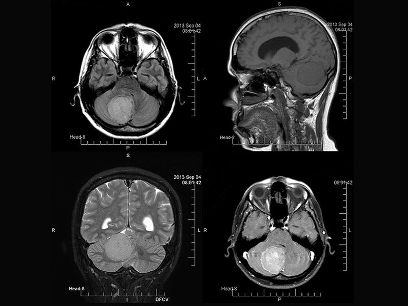 Where Does Whole Brain Radiation Fit in Lung Cancer