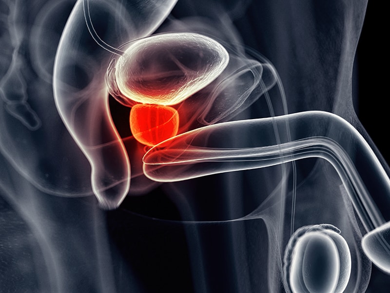 chronic prostatitis medscape