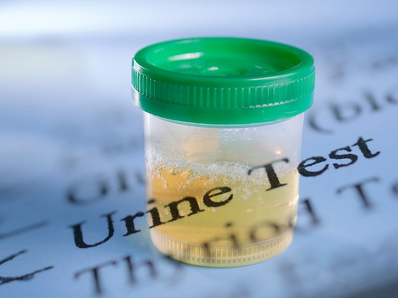 Urine Tests Miss Sexually Transmitted Infections