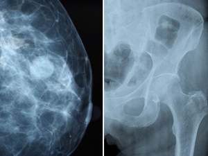 Denosumab Boosts Survival, Not Just Bones, in Breast Cancer