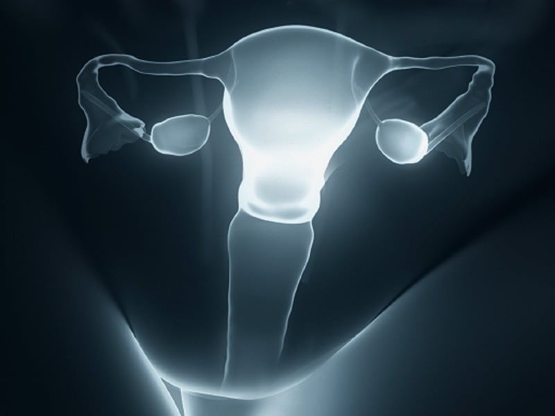 OvarySparing Hysterectomy May Accelerate Menopause Onset