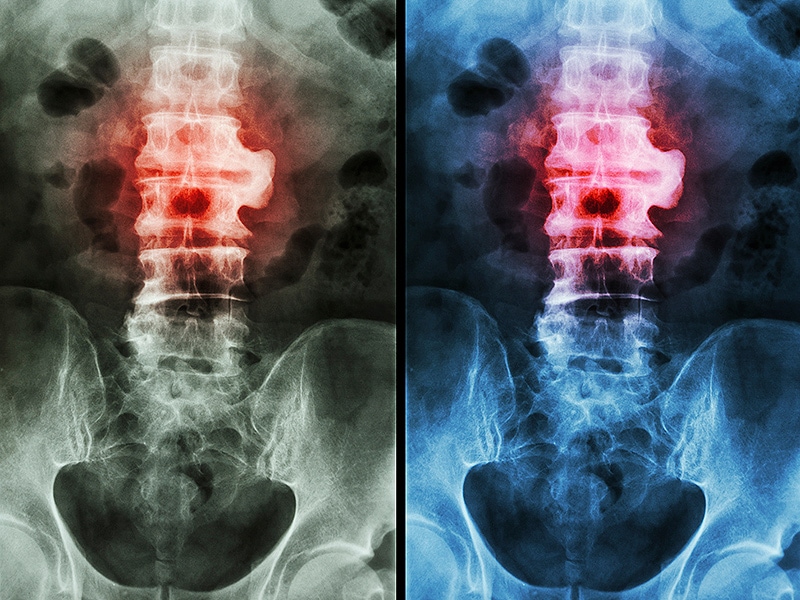 Disease Control Data, Ankylosing Spondylitis