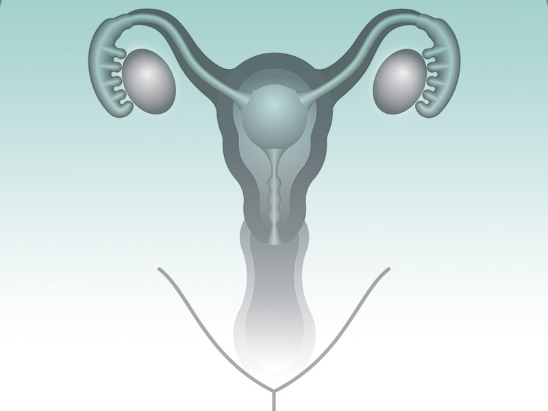 More Women Can Benefit From 'Preemptive' Ovarian Surgery