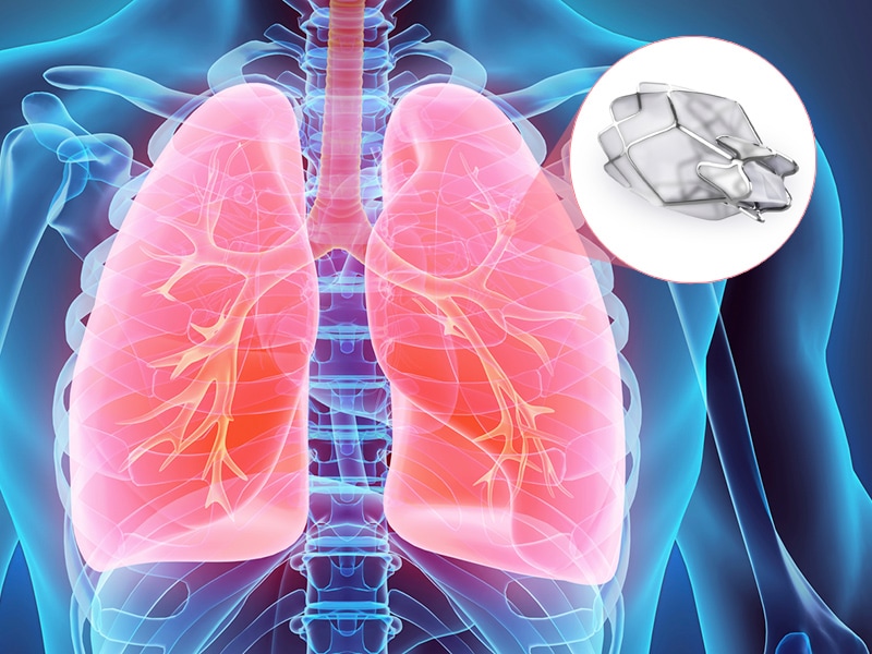 Endobronchial Valve Has IMPACT on Homogeneous Emphysema