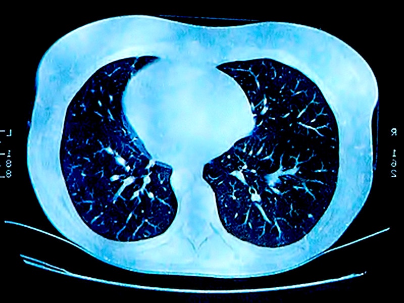 ct scan pulmonary