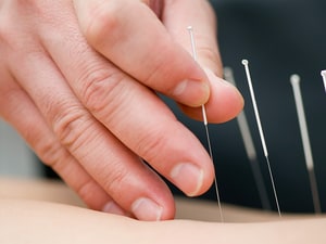 Acupuncture Helps AI Pain; Insurers Should Cover, Say Trialists
