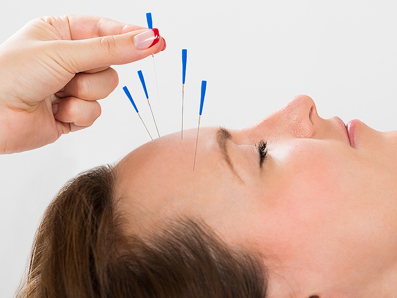 Acupuncture Useful for Migraine Prophylaxis