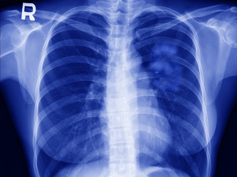 Nivolumab Quadruples 5Year Survival in NSCLC