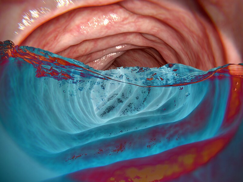 'Underwater' Colonoscopy Amplifies Polyp Detection
