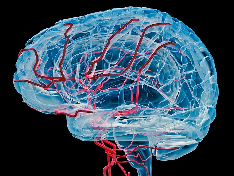 Rupture Risk Low for Small Cerebral Aneurysms