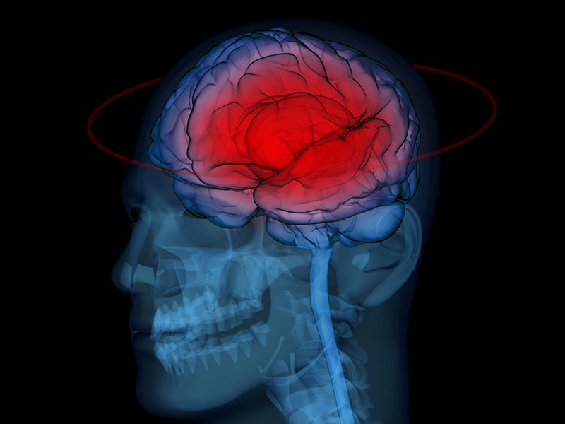 Brain injury