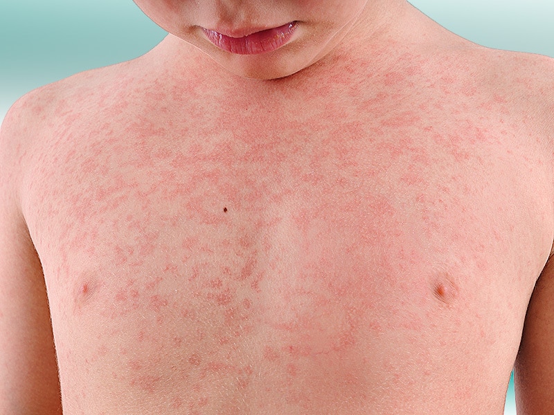 when-allergic-to-penicillin-isn-t-true-in-children