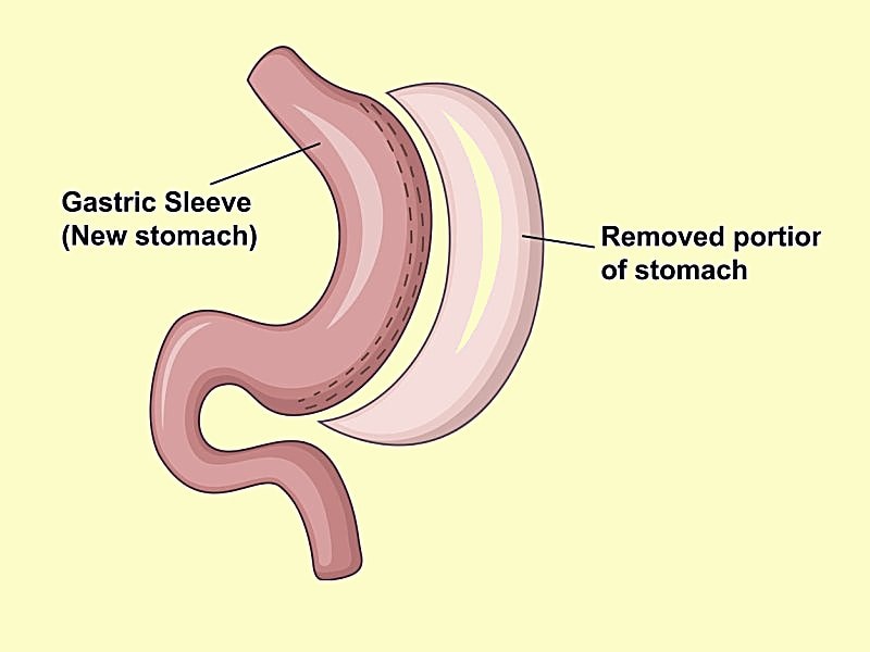 laparoscopic-sleeve-gastrectomy-good-operation-with-limits