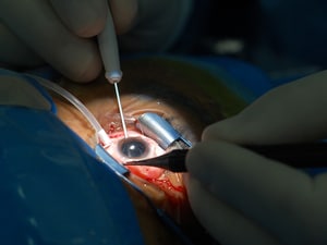 Novel Intraocular Lens May Prevent Negative Dysphotopsia