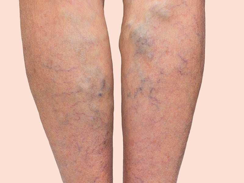 Varicose Veins Tied To Higher Risk For Deep Venous - 