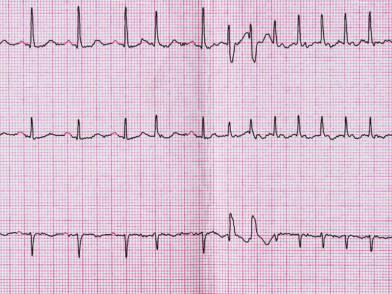 At-Home, Wearable ECG Patch May Improve Early Detection of AF