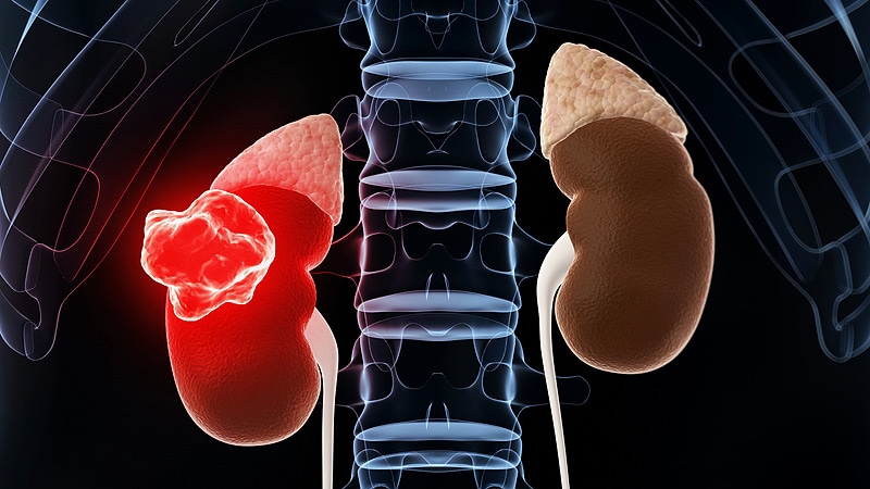 Immunotherapy Plus Targeted Drug in FirstLine Kidney Cancer