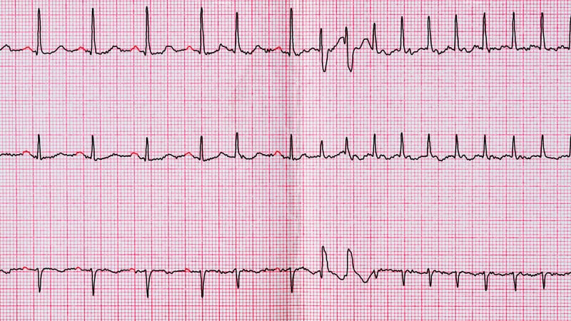 AF Guideline Update Prefers NOACs to Warfarin in Most Cases