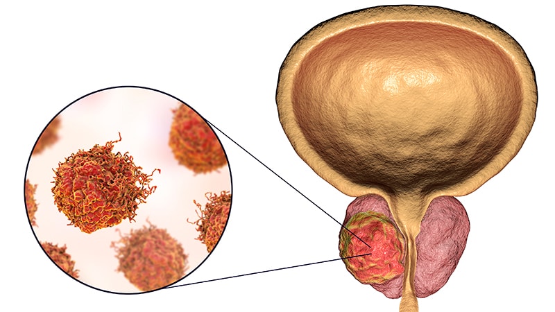 Darolutamide Extends Survival in Metastatic Prostate Cancer - NCI