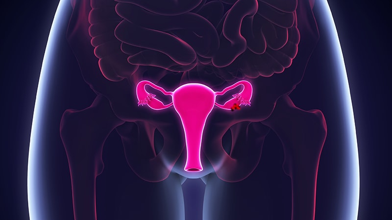 «Énorme pas en avant» dans le cancer de l’ovaire avancé