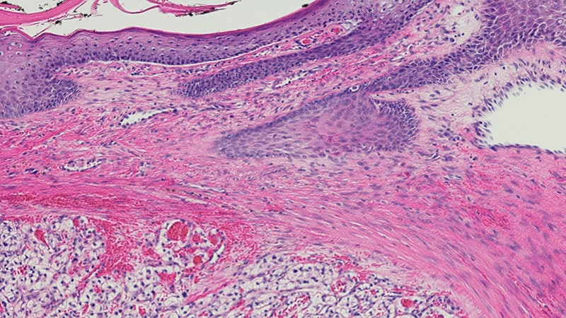 Non clear cell renal carcinoma