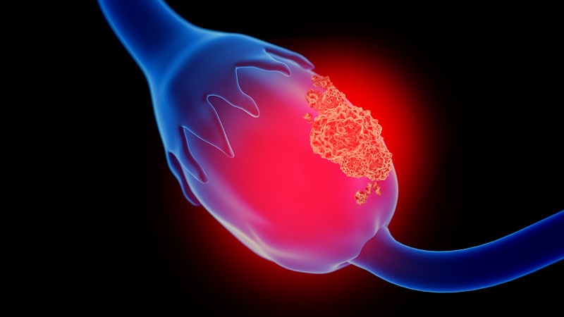La chirurgie de réduction devrait intervenir peu de temps après la NACT dans le cancer de l’ovaire