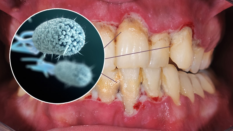 mouth infected with gum disease, teeth browned, bloody gums and bacteria, dental cleaning Melrose, MA dentist 