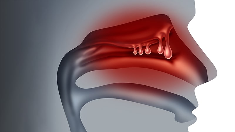 Nasal Polyps May Increase Risk of Cancer in the Nasal Cavities