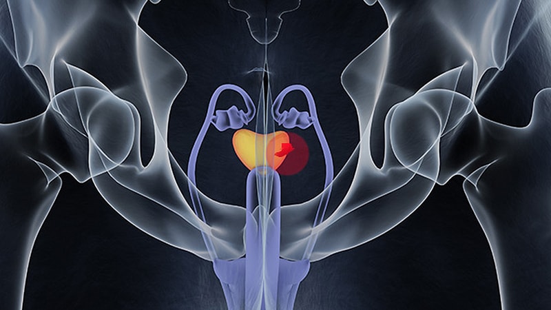 medscape prostate cancer treatment