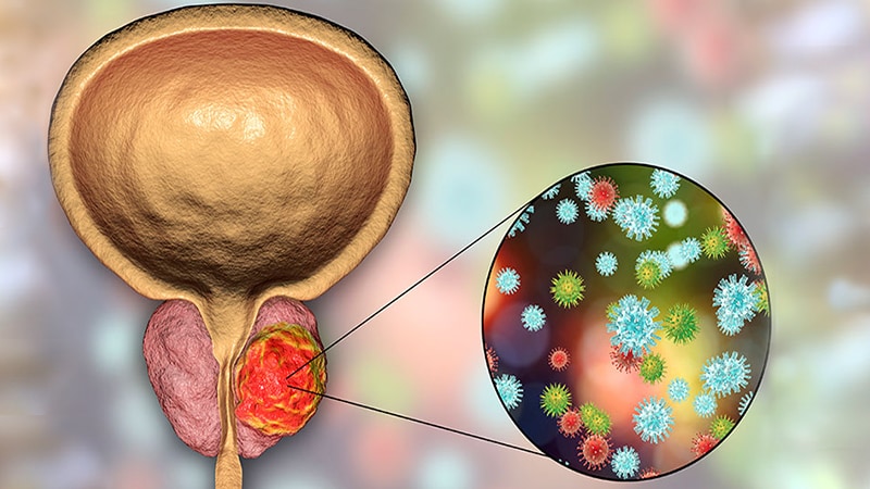 Prostate cancer management medscape - hCG, mint tumor marker | Lab Tests Online-HU