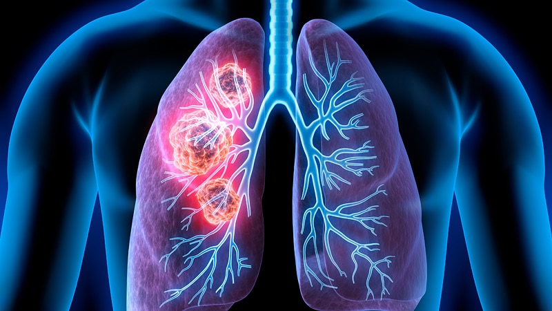 Revolutionary 'Death Star' Targeting Lung Cancer Drug Available on the NHS