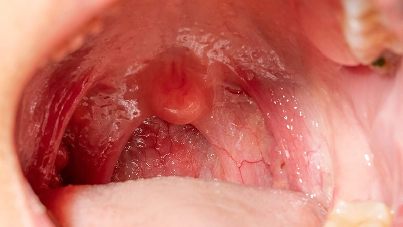 human papillomavirus and mouth cancer)