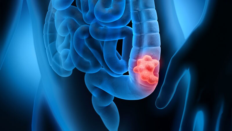 Gastric cancer medscape Cancer gastric ( neoplasmul gastric ) - BeHealthy