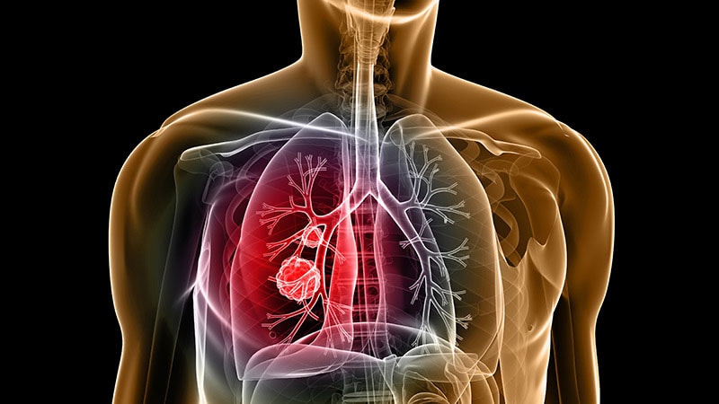 Sintilimab Scintillates in First-line Non-squamous NSCLC