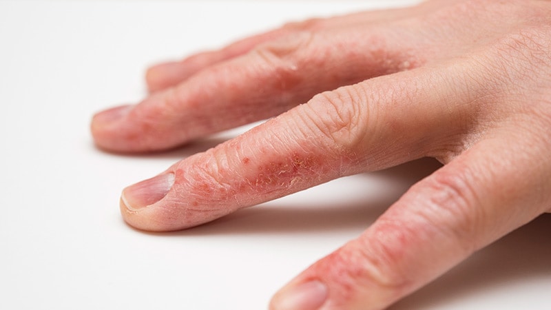 Dry Itchy Flaky Skin On Fingers