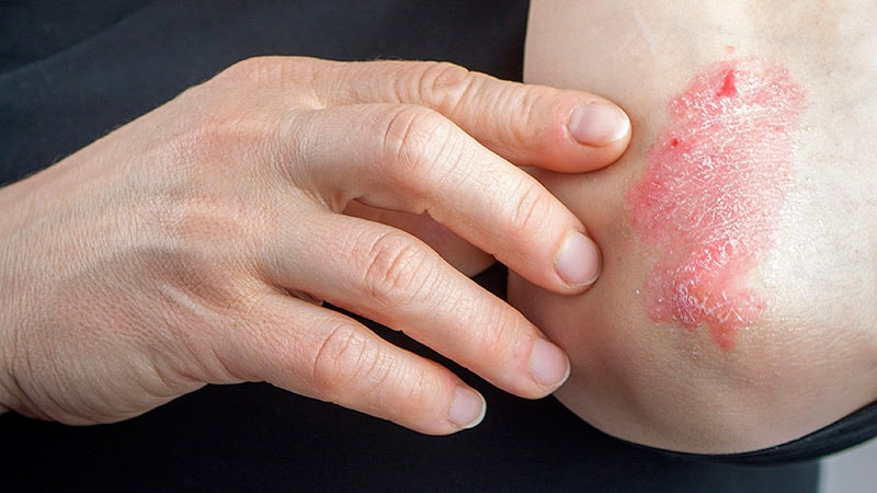Kartalin psoriasis útmutató