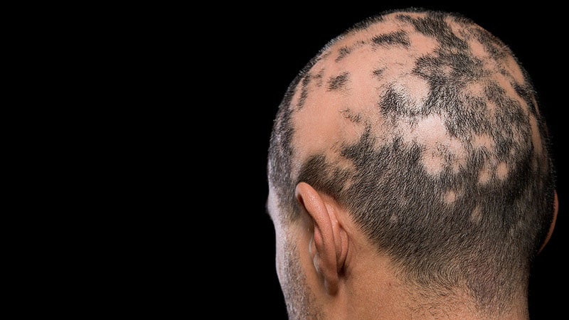 La alopecia areata se cura sola
