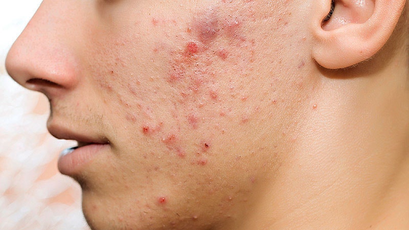 La FDA approuve un traitement topique triple combiné pour l’acné