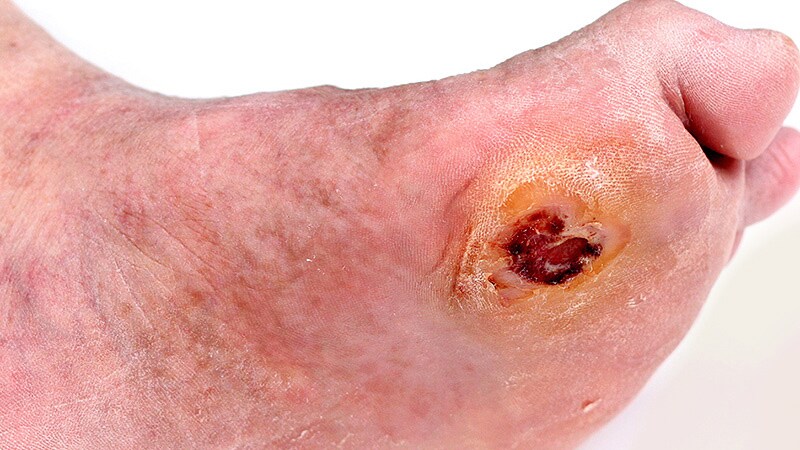 New Strategies for Preventing and Healing Diabetic Foot