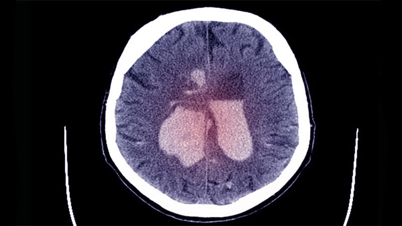 Avantages de la thrombectomie pour les accidents vasculaires cérébraux avec de grands volumes centraux : SELECT2