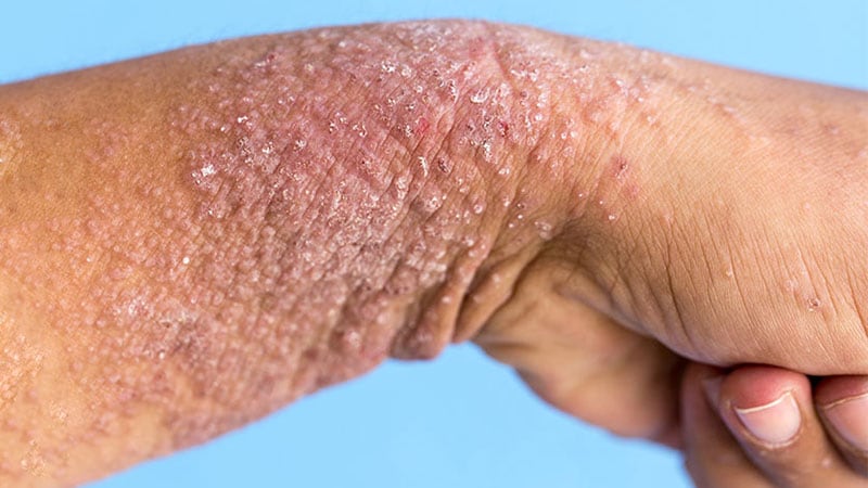 De nouvelles données prévoient plus d’inhibiteurs oraux de la PDE4 pour le psoriasis