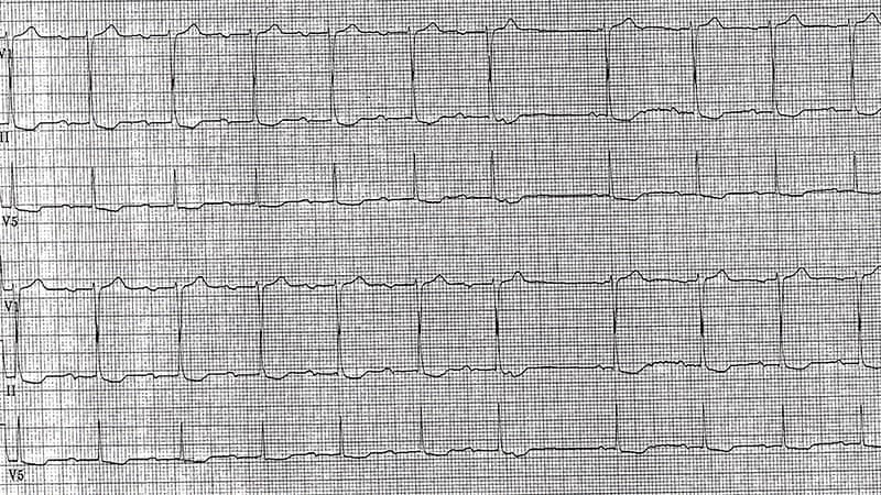 ecg-challenge-a-34-year-old-with-sporadic-palpitations