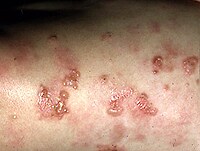 Reduced Mortality in Dermatitis Herpetiformis