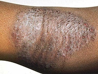 Atopic Dermatitis and Hypersensitivity Reactions