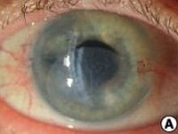 Descemet Membrane Detachment After Cataract Surgery