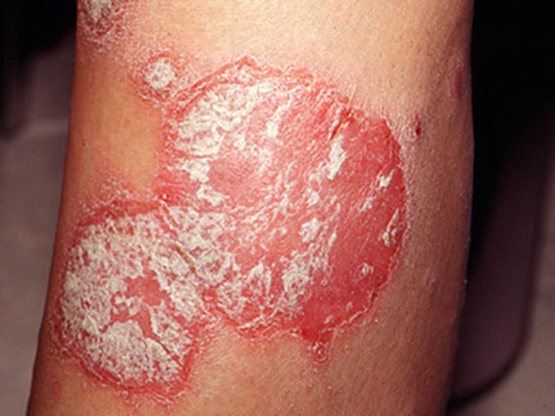 Bacterial DNA in Blood Linked to Psoriasis Flare
