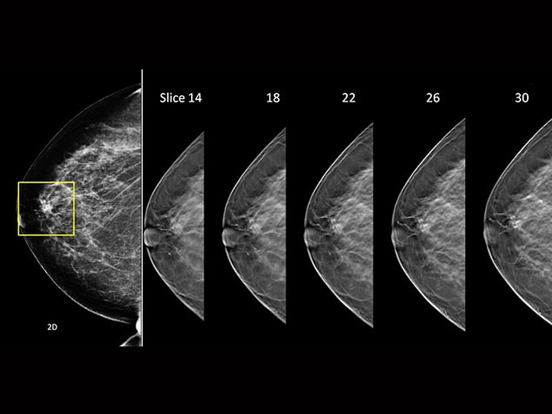 Breast Tomosynthesis